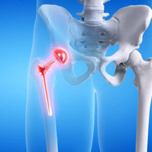 artoplastia de cadera reemplazo total parcial de cadera, cirugia en traumatologia, protesis de cadera, desgaste de cadera, Osteoartrosis de cadera, Artritis reumatoide, Malformaciones articulares de la cadera, Fracturas o luxaciones de cadera