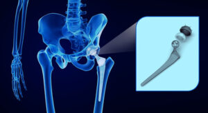 artoplastía, artoplastia de cadera, cirugia de cadera, operacion de cadera, Pinzamiento femoroacetabular, cartilagos cadera, artritis reumatoide, membrana sinovial, sinovitis, Osteoartritis de cadera, fractura cadera, huesos cadera, infecciones de cadera, artritis séptica de la cadera, dolor de cadera, rigidez de cadera