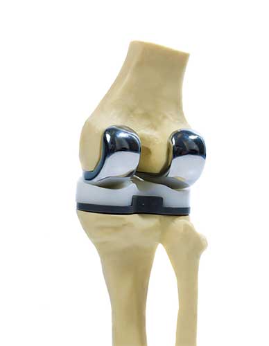 artoplastia de rodilla, cirugia de rodilla, reemplazo de rodilla, reemplazo articular, cartilago dañado, protesis de rodilla, osteoartritis de rodilla, artritis reumatoide, dr vilchez, traumatologo en san pedro, tramatologia deportiva