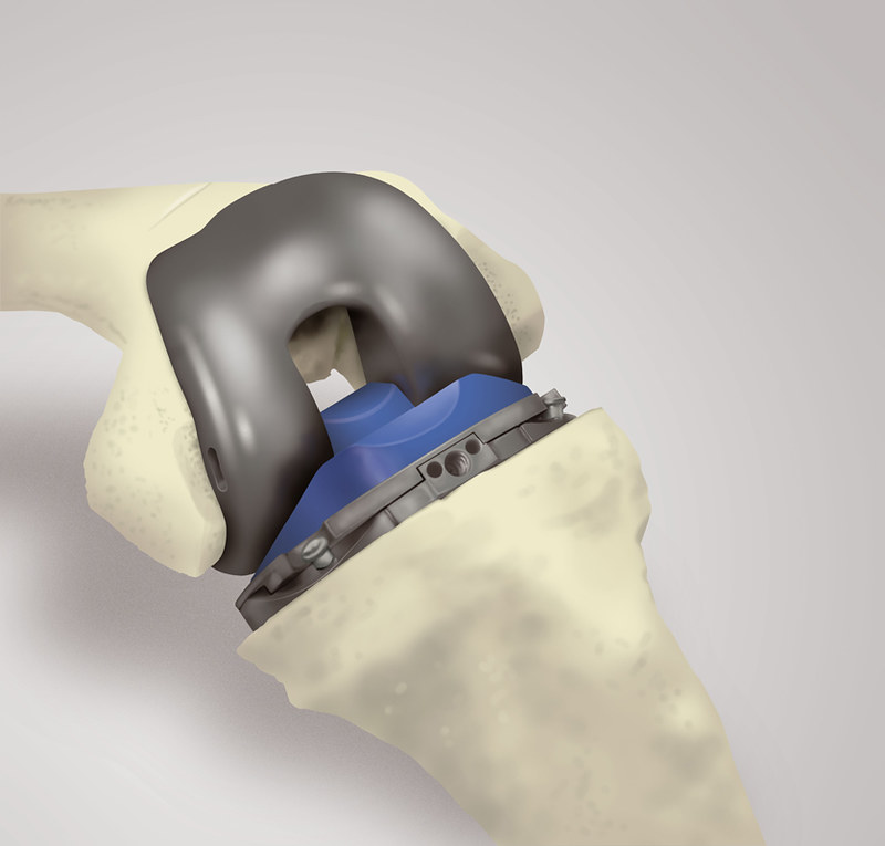 Artroplastia De Rodilla Dr Vilchez