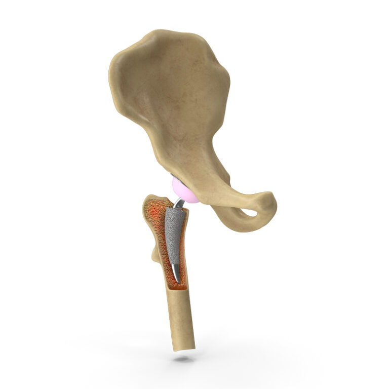 tratamiento, cadera, articular, reemplazo, artroplastia cadera, protesis cadera, osteoartritis cadera, artrosis cadera, reemplazo total, reemplazo articular cadera, colocación prótesis cadera, dolor de cadera, rigidez de cadera,