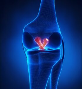 lesion ligamento cruzado anterior, tendon rotuliano, , ruptura de ligamento, lesion LCA, ruptura de ruzados, desgarro de ligamento cruzado anterior, ruptura del LCA, dr vilchez, traumatologo en san pedro, lesiones deportivas, tramatologia deportiva, rodilla
